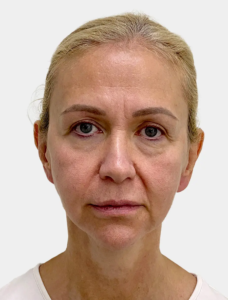 Resultado Lip Lift 1